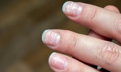 These are the health issue if your nails turn into white color These are the health issue if your nails turn into white color