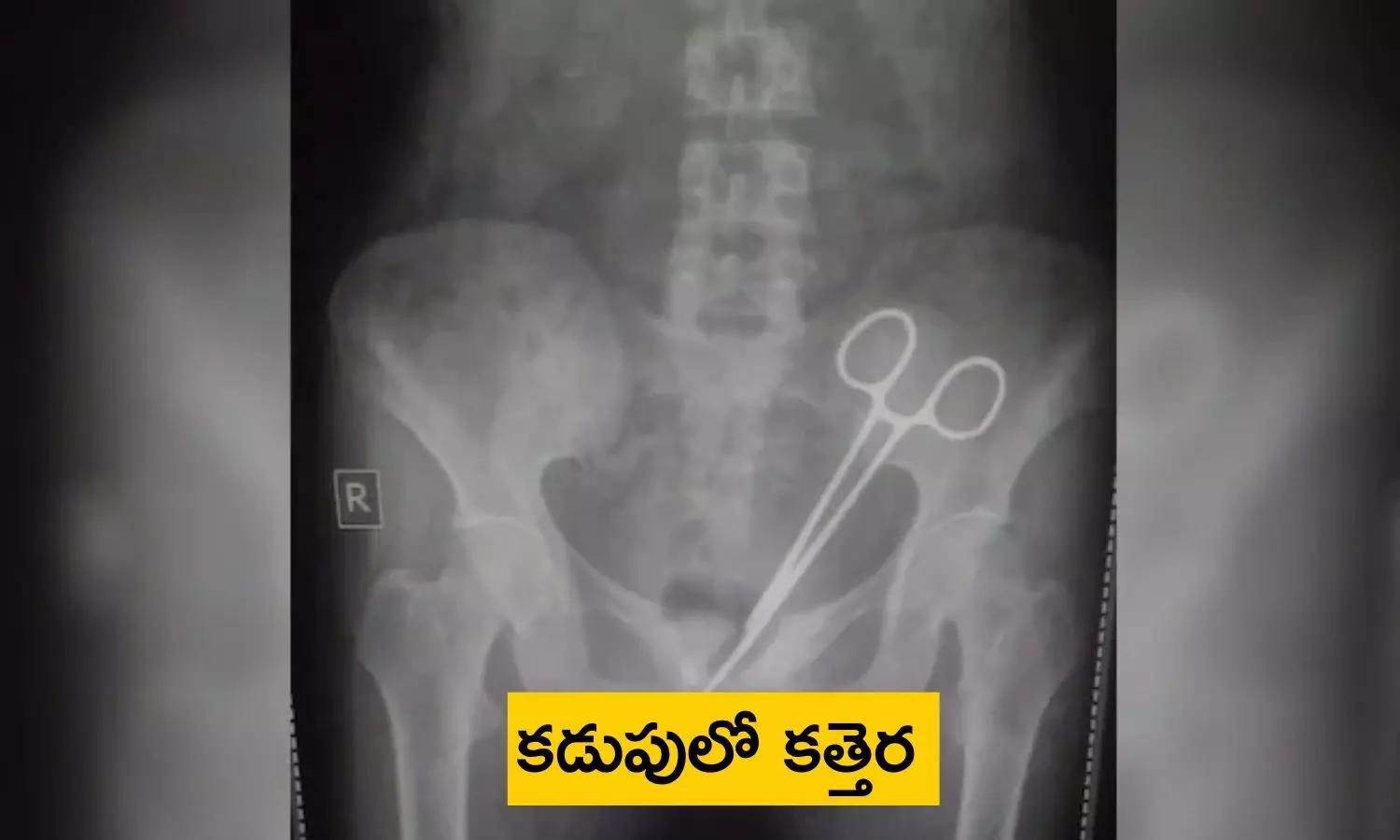 Scissors In Abdomen: కడుపునొప్పి అని వెళ్తే.. పొట్టలో కత్తెర పెట్టి కుట్లేశారు