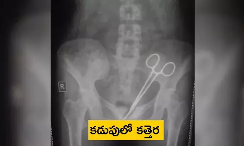 Scissors In Abdomen: కడుపునొప్పి అని వెళ్తే.. పొట్టలో కత్తెర పెట్టి కుట్లేశారు