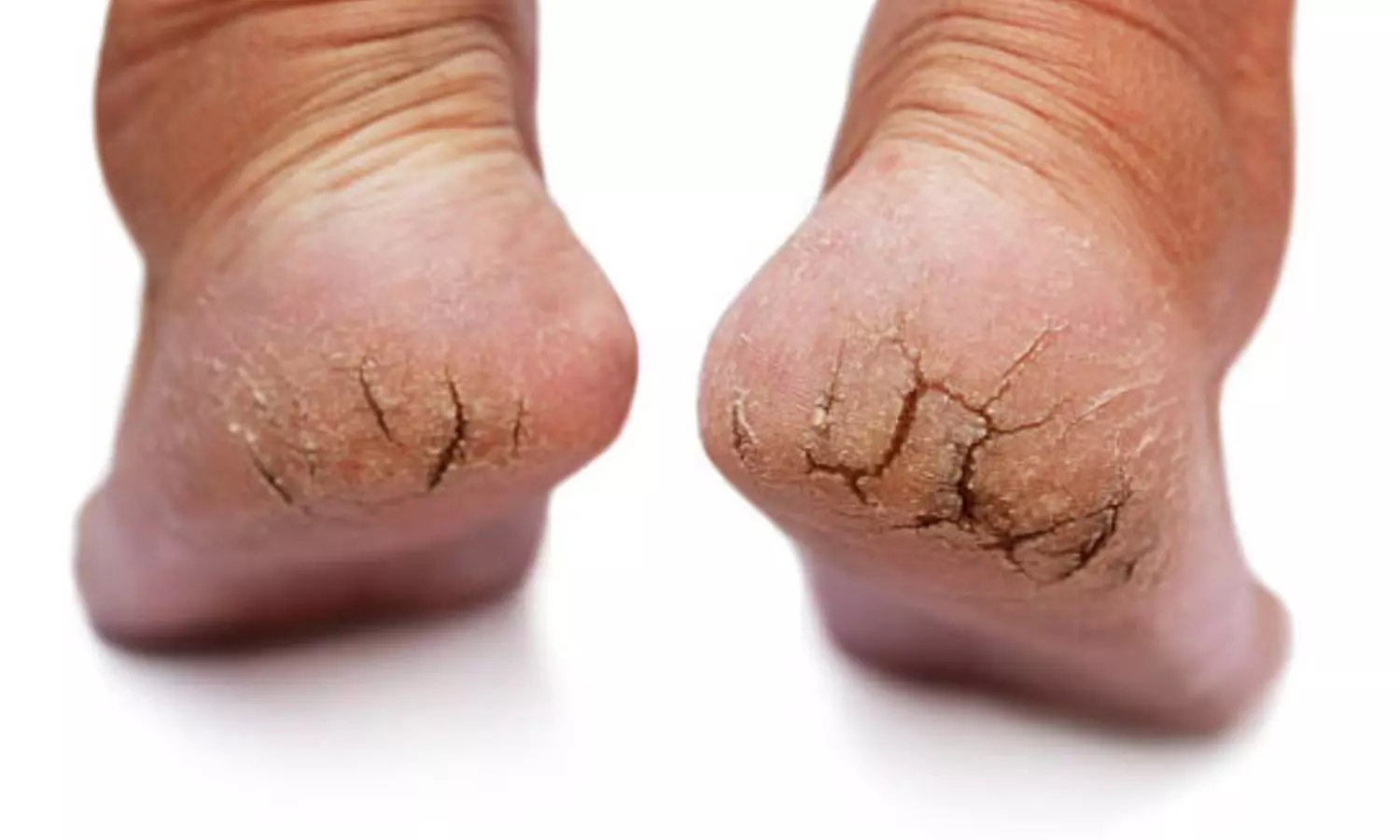 Follow These Natural Tips to Overcome From Cracked Heels in Winter