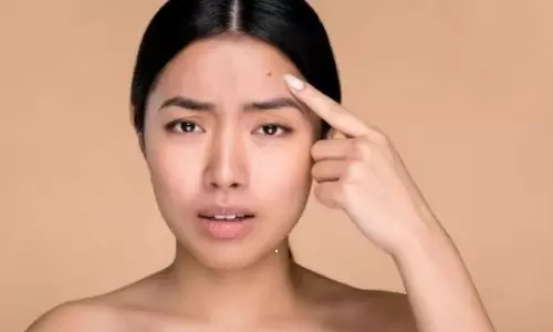 Is eating fish good for pimples?