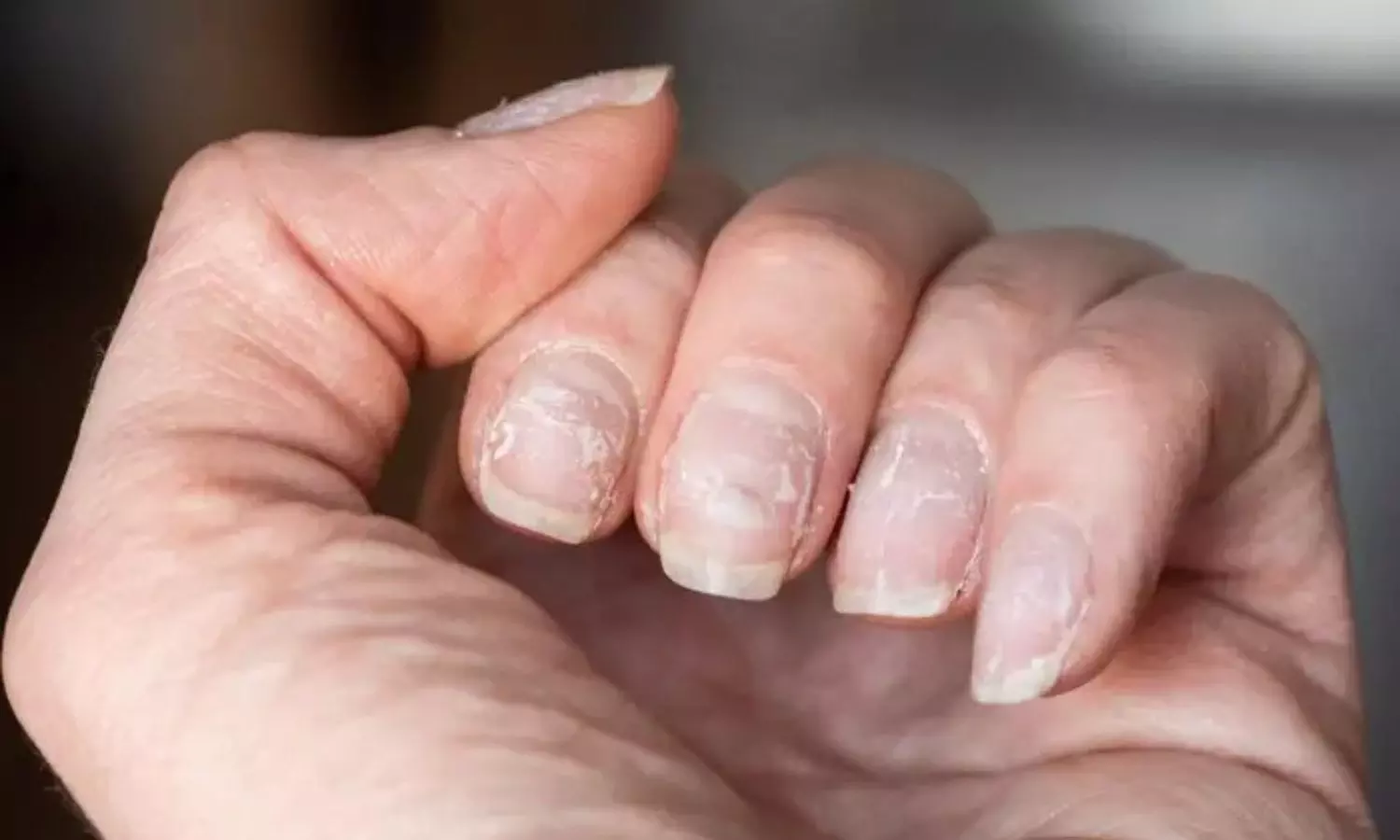 Early symptoms of several health issues alerts through unhealthy nails