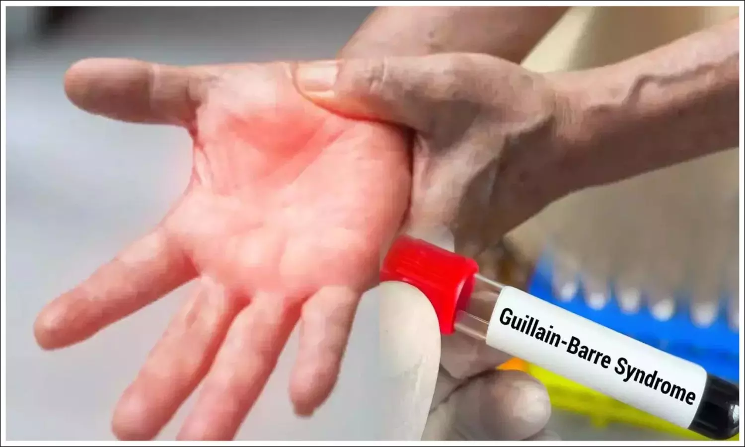 Guillain Barre Syndrome outbreak in AP Check Symptoms Guillain Barre Syndrome outbreak in AP Check Symptoms