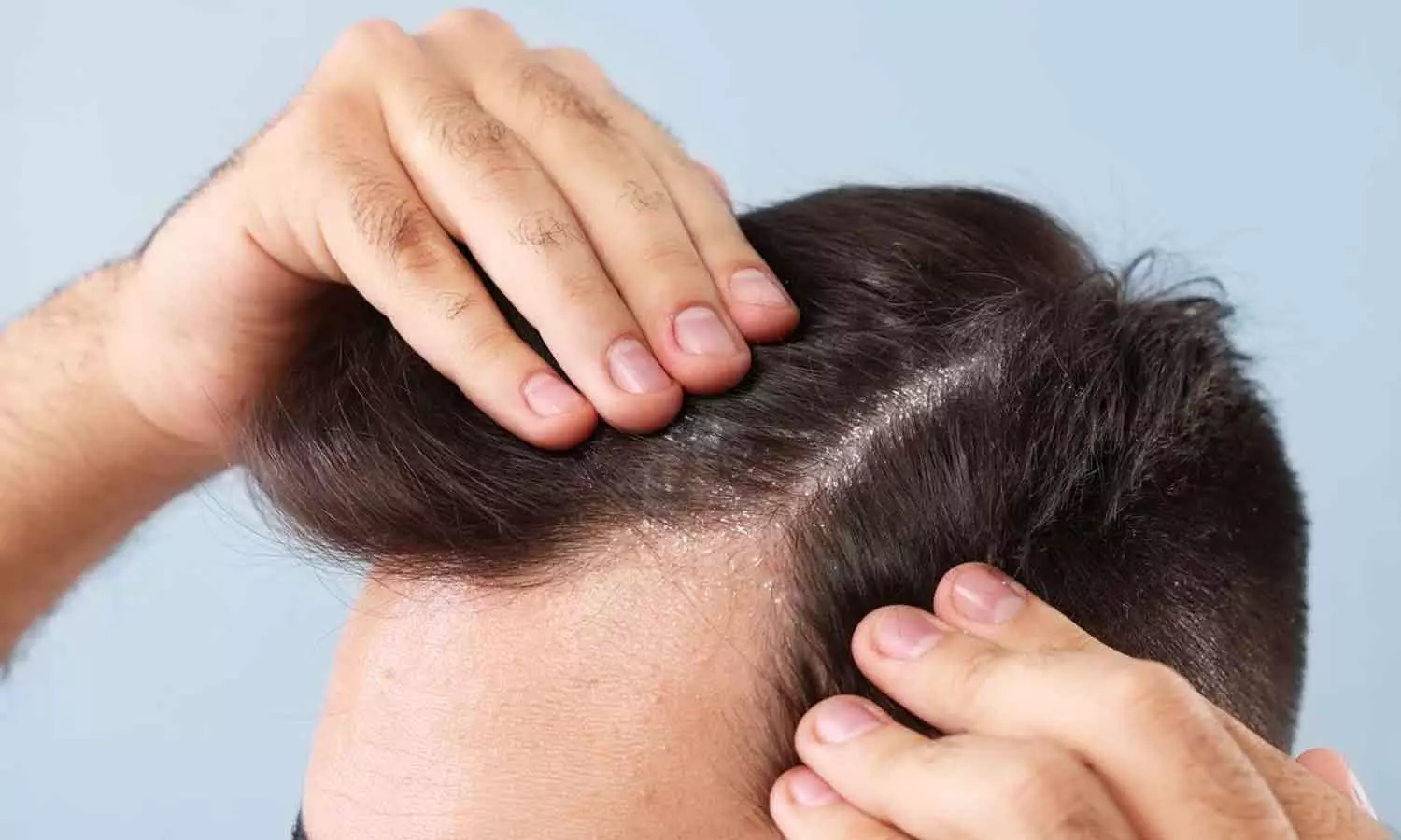 Dandruff: చుండ్రు రావడానికి అసలు కారణం ఏంటి.? ఇంటి చిట్కాలతో ఎలా చెక్‌ పెట్టాలి.?