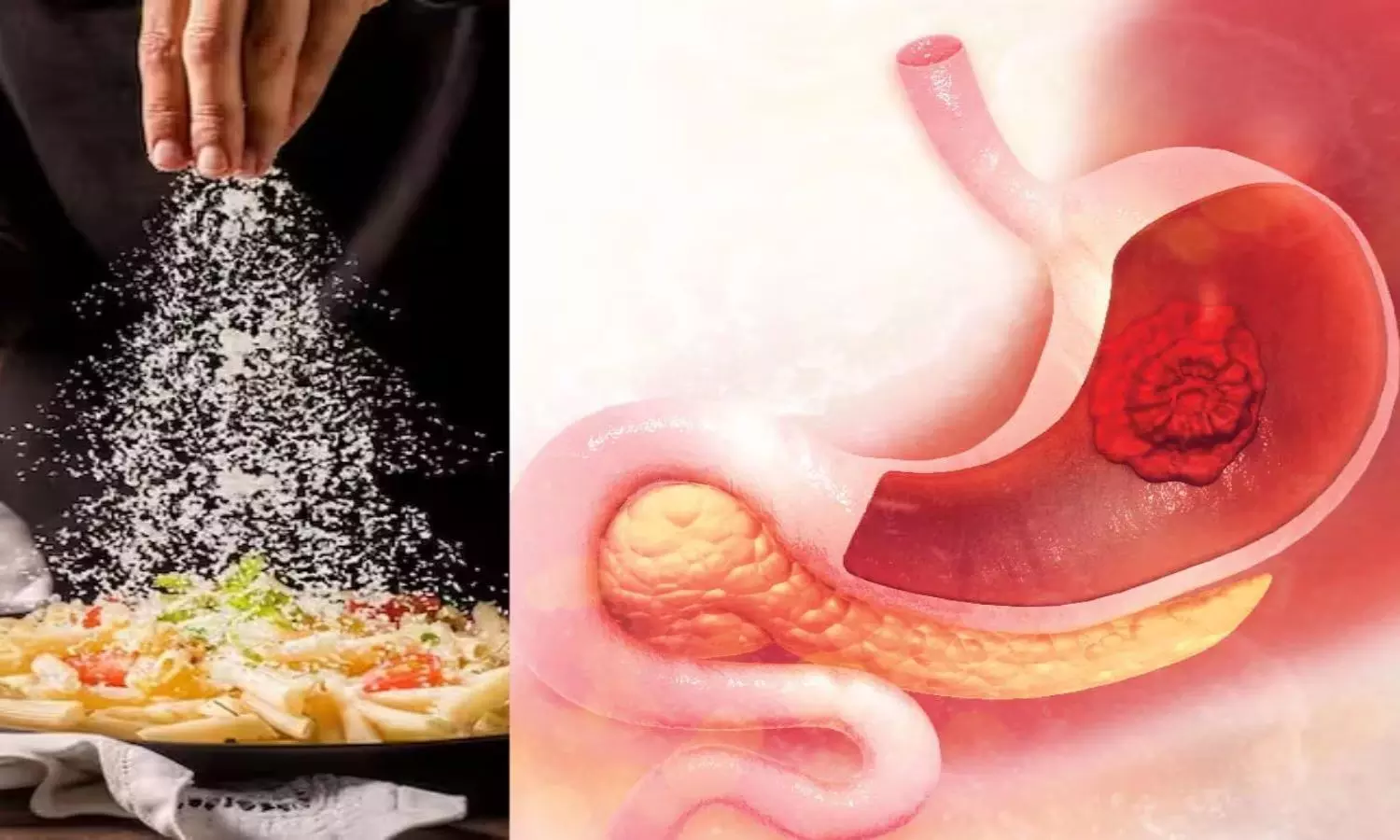 Excess Salt in Diet Linked to Increased Stomach Cancer Risk