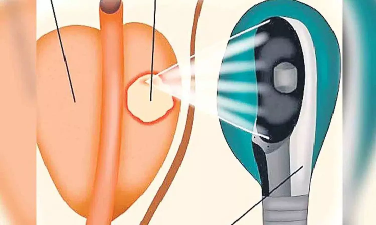 Prostate Cancer: సర్జరీ లేకుండానే ప్రొస్టేట్ క్యాన్సర్ కు చెక్