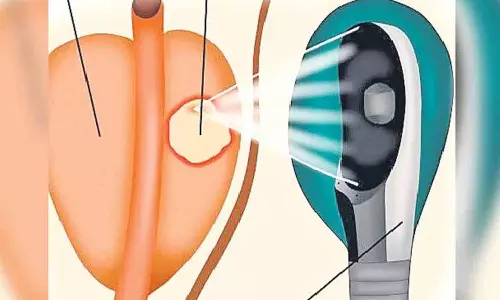 Prostate Cancer: సర్జరీ లేకుండానే ప్రొస్టేట్ క్యాన్సర్ కు చెక్