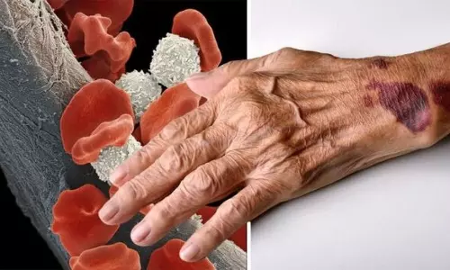 Blood Cancer Symptoms: Early Signs, Causes and Treatment Options