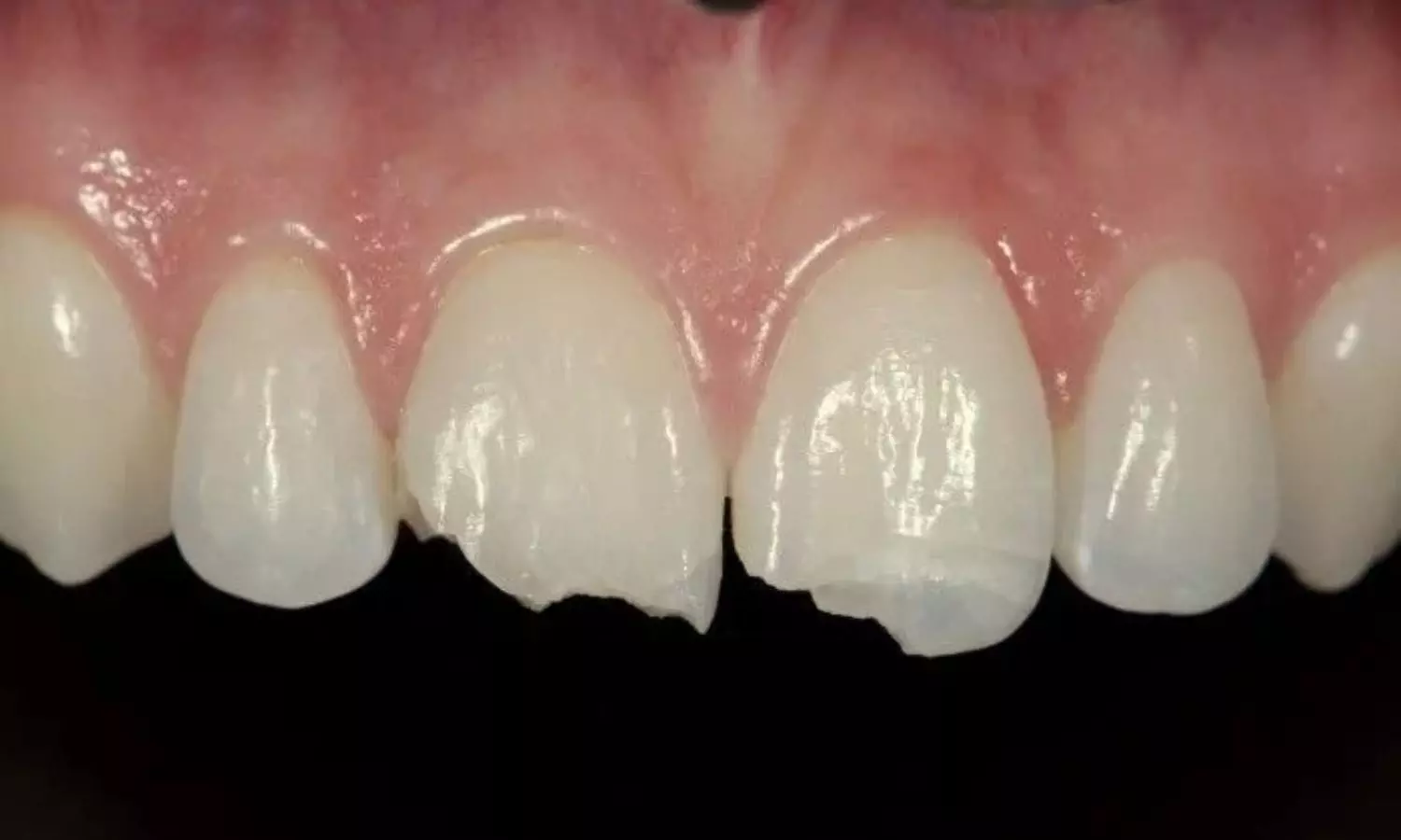 Breakthrough in Dental Care Scientists Make Human Teeth in Lab Telugu News