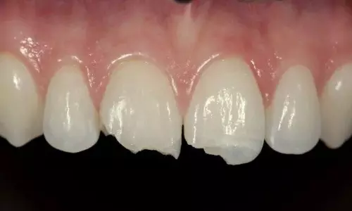 Breakthrough in Dental Care Scientists Make Human Teeth in Lab Telugu News