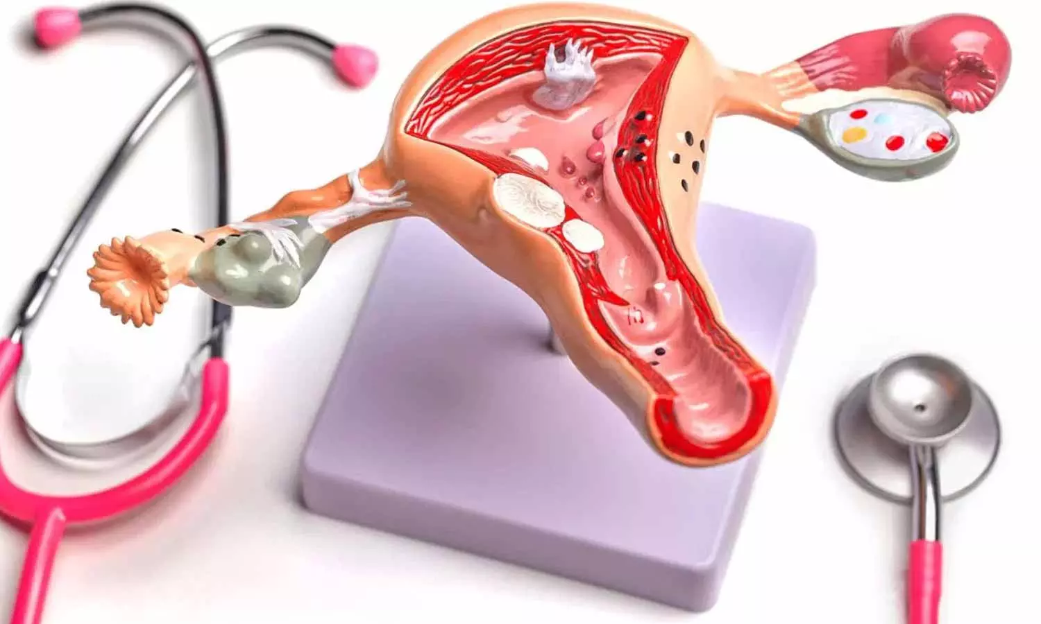 Uterine Cancer