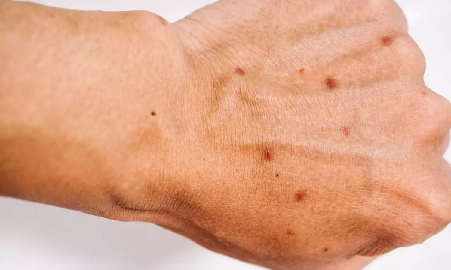 Diabetes  : డ‌యాబెటిస్ వ‌చ్చింద‌ని చ‌ర్మ‌మే చెబుతుందా? ఈ ప్రారంభ సంకేతాల‌ను గుర్తించండి !