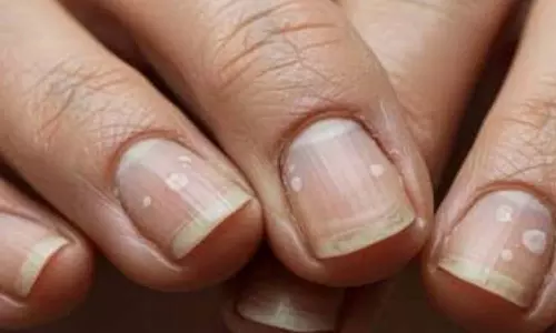 Nails: గోళ్ళపై తెల్లని మచ్చలు ఎందుకు ఉంటాయి? ఇది ఏ వ్యాధి లక్షణం.!
