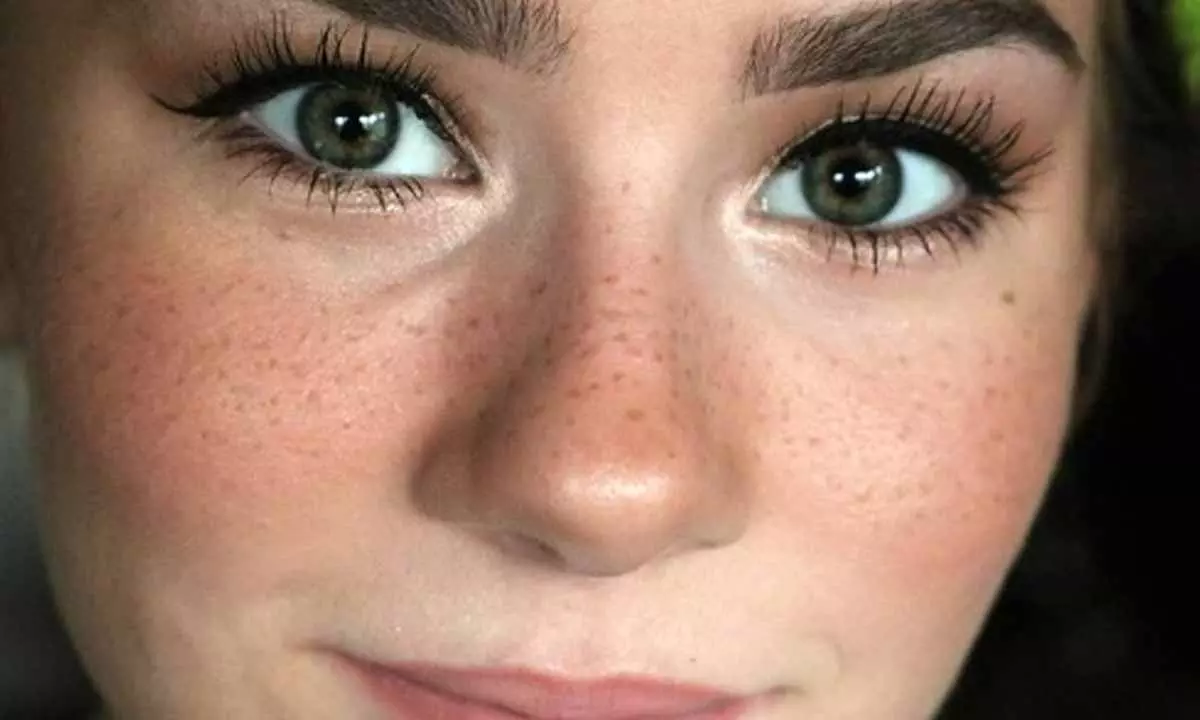 Freckles Freckles