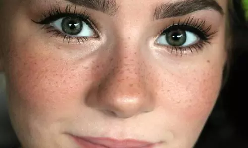 Freckles