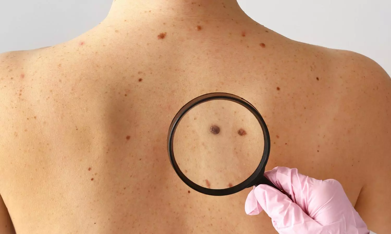 Moles Cancer Moles Cancer