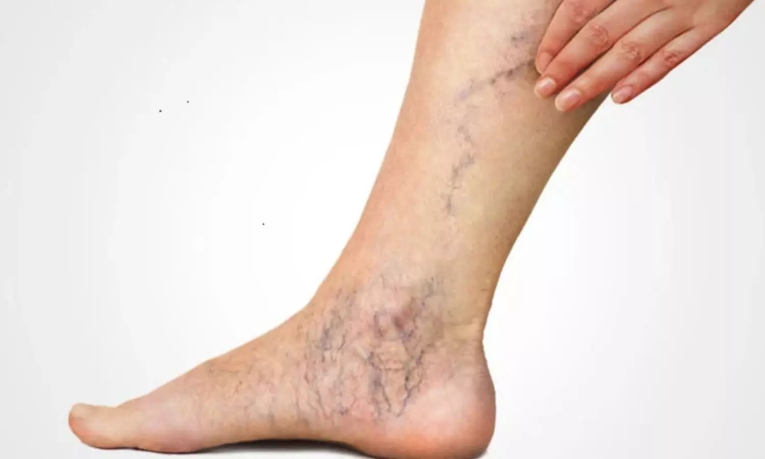 Why Do Varicose Veins Happen Simple and Effective Ways to Treat Them