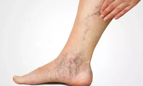 Why Do Varicose Veins Happen Simple and Effective Ways to Treat Them