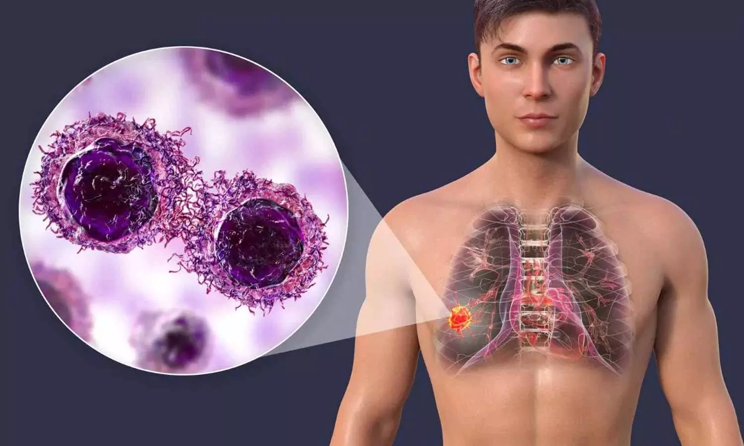 Lung Cancer Lung Cancer