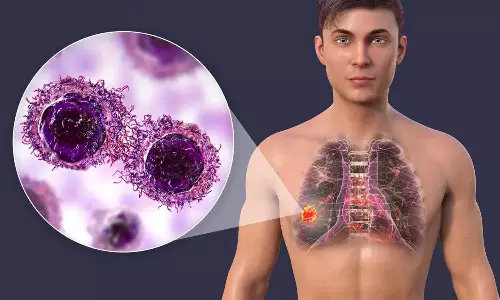 Lung Cancer Lung Cancer