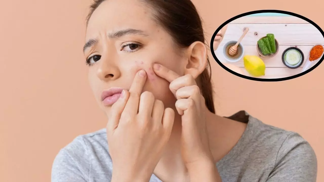 Pimples: మొటిమలతో ఇబ్బంది పడుతున్నారా? ఈ సులభమైన చిట్కాలు పాటించండి తక్కువ సమయంలో తగ్గిపోతాయి! Pimples: మొటిమలతో ఇబ్బంది పడుతున్నారా? ఈ సులభమైన చిట్కాలు పాటించండి తక్కువ సమయంలో తగ్గిపోతాయి!