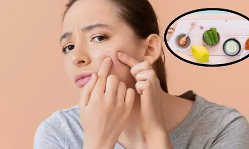 Pimples: మొటిమలతో ఇబ్బంది పడుతున్నారా? ఈ సులభమైన చిట్కాలు పాటించండి తక్కువ సమయంలో తగ్గిపోతాయి!