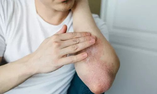 Monsoon Health Alert: వర్షాకాలంలో ఫంగల్ ఇన్ఫెక్షన్ల పట్ల జాగ్రత్త.. ఈ లక్షణాలు కనిపిస్తే అస్సలు నిర్లక్ష్యం చేయవద్దు! Monsoon Health Alert: వర్షాకాలంలో ఫంగల్ ఇన్ఫెక్షన్ల పట్ల జాగ్రత్త.. ఈ లక్షణాలు కనిపిస్తే అస్సలు నిర్లక్ష్యం చేయవద్దు!