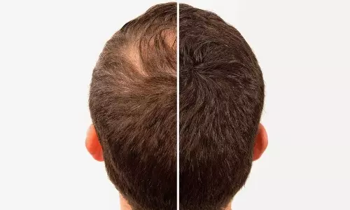 Hair Growth