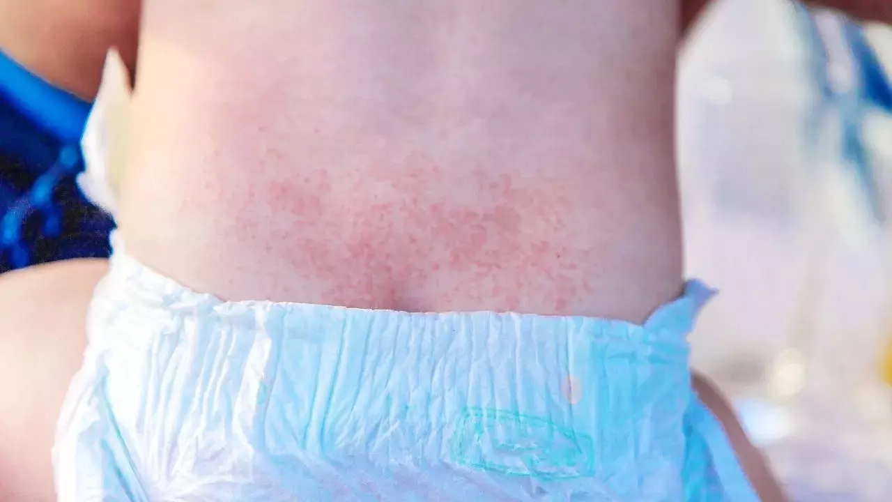 Diaper Rashes : పాపకు డైపర్ వేస్తే చర్మం ఎర్రగా అవుతుందా? డోంట్ వర్రీ.. ఈజీగా నయం చేసే టిప్స్ ఇవే