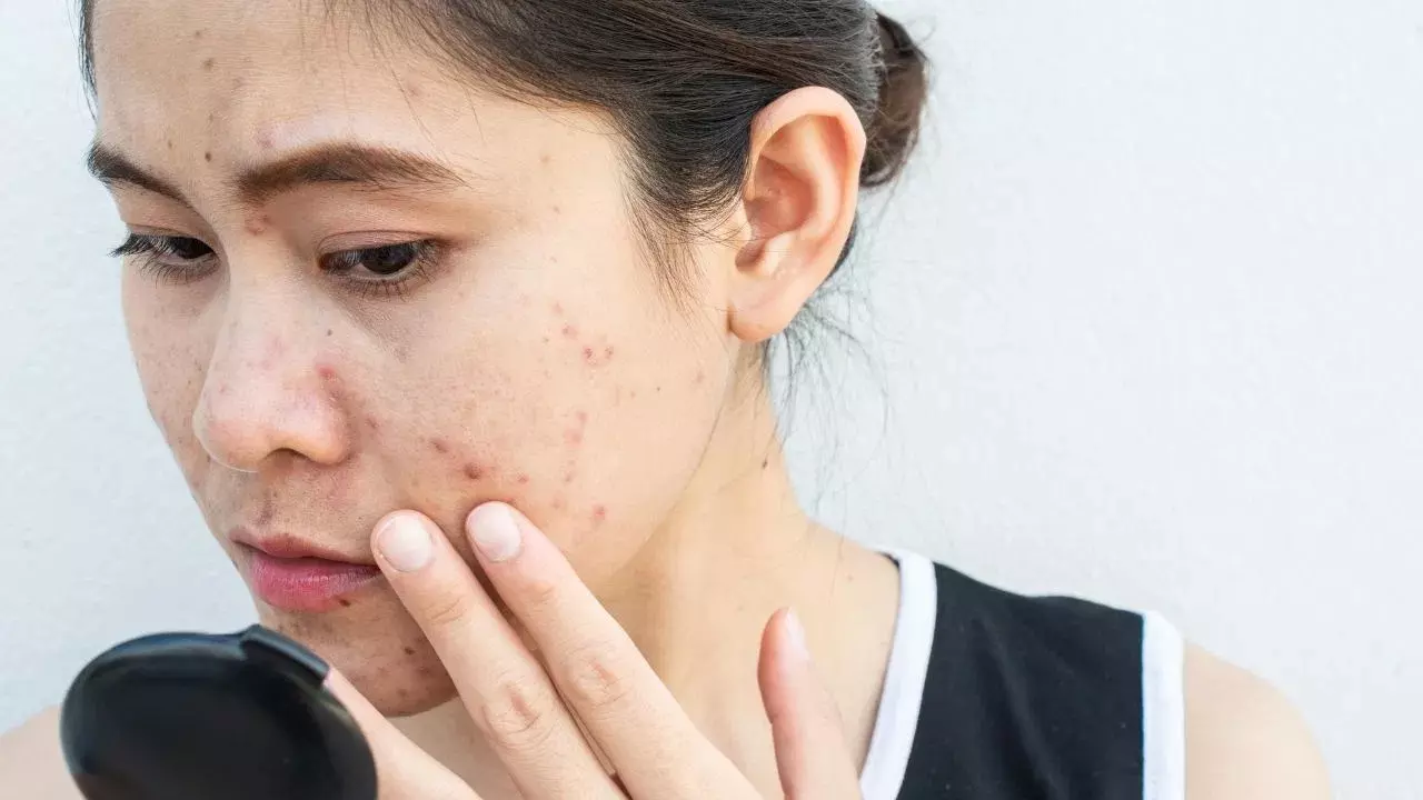 Pimples : పదేపదే మొటిమలు మీ అందాన్ని పాడు చేస్తున్నాయా? వీటిని తగ్గించుకోవడం చాలా ఈజీ Pimples : పదేపదే మొటిమలు మీ అందాన్ని పాడు చేస్తున్నాయా? వీటిని తగ్గించుకోవడం చాలా ఈజీ