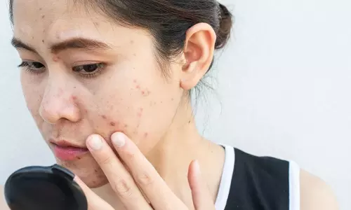 Pimples : పదేపదే మొటిమలు మీ అందాన్ని పాడు చేస్తున్నాయా? వీటిని తగ్గించుకోవడం చాలా ఈజీ