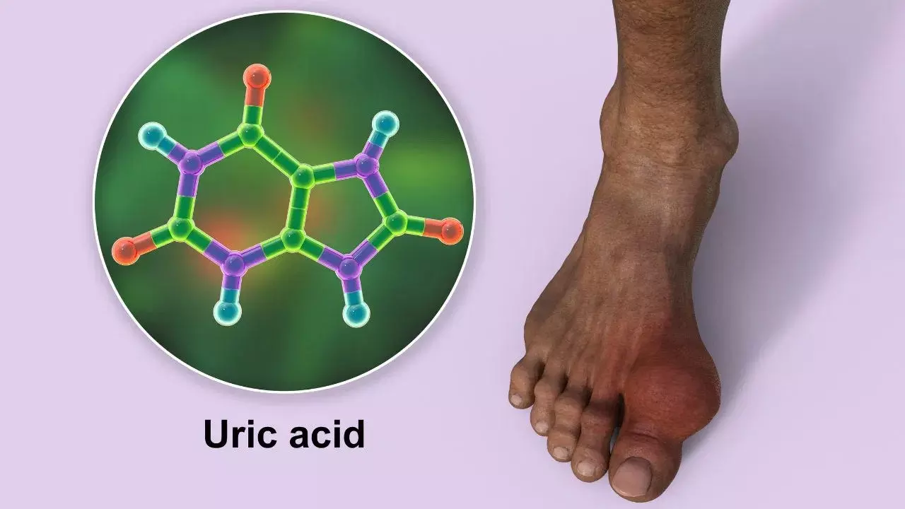 Uric Acid : యూరిక్ యాసిడ్ పెరిగితే కనిపించే లక్షణాలు ఏంటి? దీన్ని ఎలా కంట్రోల్ చేయాలి? Uric Acid : యూరిక్ యాసిడ్ పెరిగితే కనిపించే లక్షణాలు ఏంటి? దీన్ని ఎలా కంట్రోల్ చేయాలి?