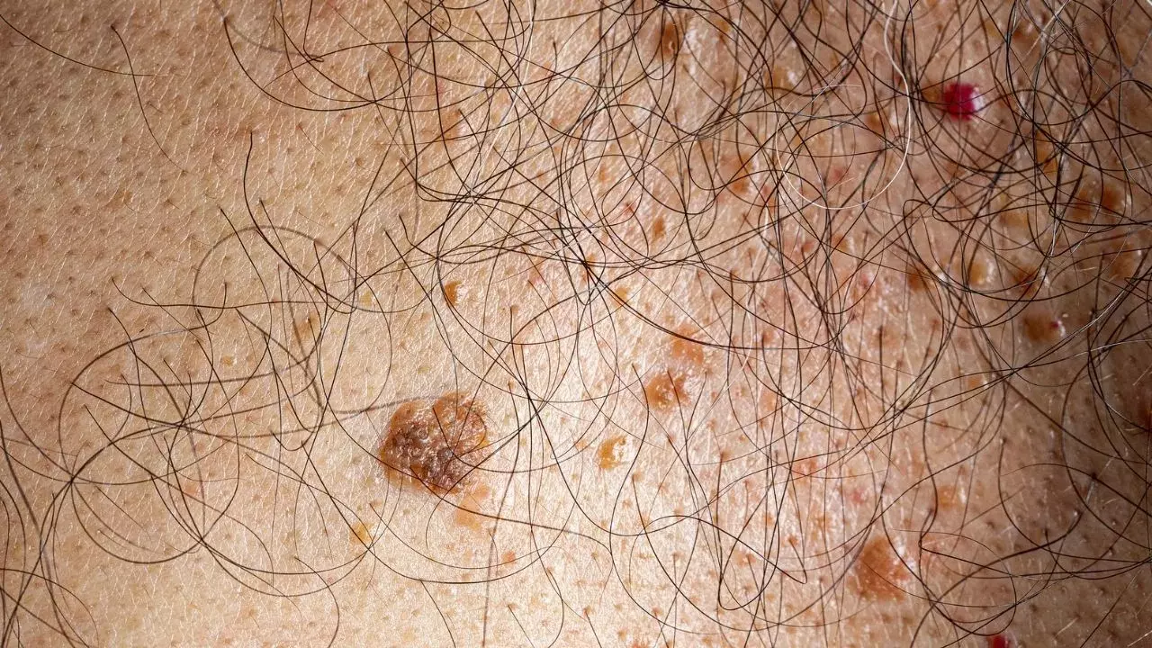 Skin Cancer : శరీరంలోని పుట్టుమచ్చలు క్యాన్సర్‌కు కారణమవుతాయా? నిపుణులు ఏమన్నారంటే