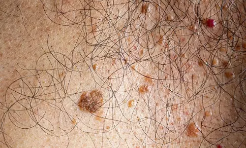 Skin Cancer : శరీరంలోని పుట్టుమచ్చలు క్యాన్సర్‌కు కారణమవుతాయా? నిపుణులు ఏమన్నారంటే