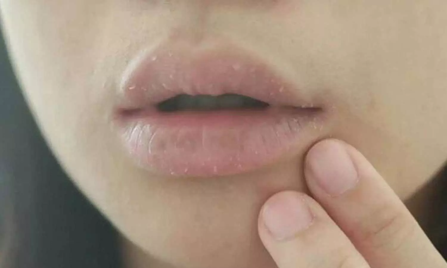 Winter Chapped Lips Winter Chapped Lips