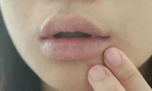 Winter Chapped Lips Winter Chapped Lips