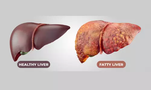 Fatty Liver: ఫ్యాటీ లివర్కు చెక్ పెట్టండిలా! Fatty Liver: ఫ్యాటీ లివర్కు చెక్ పెట్టండిలా!