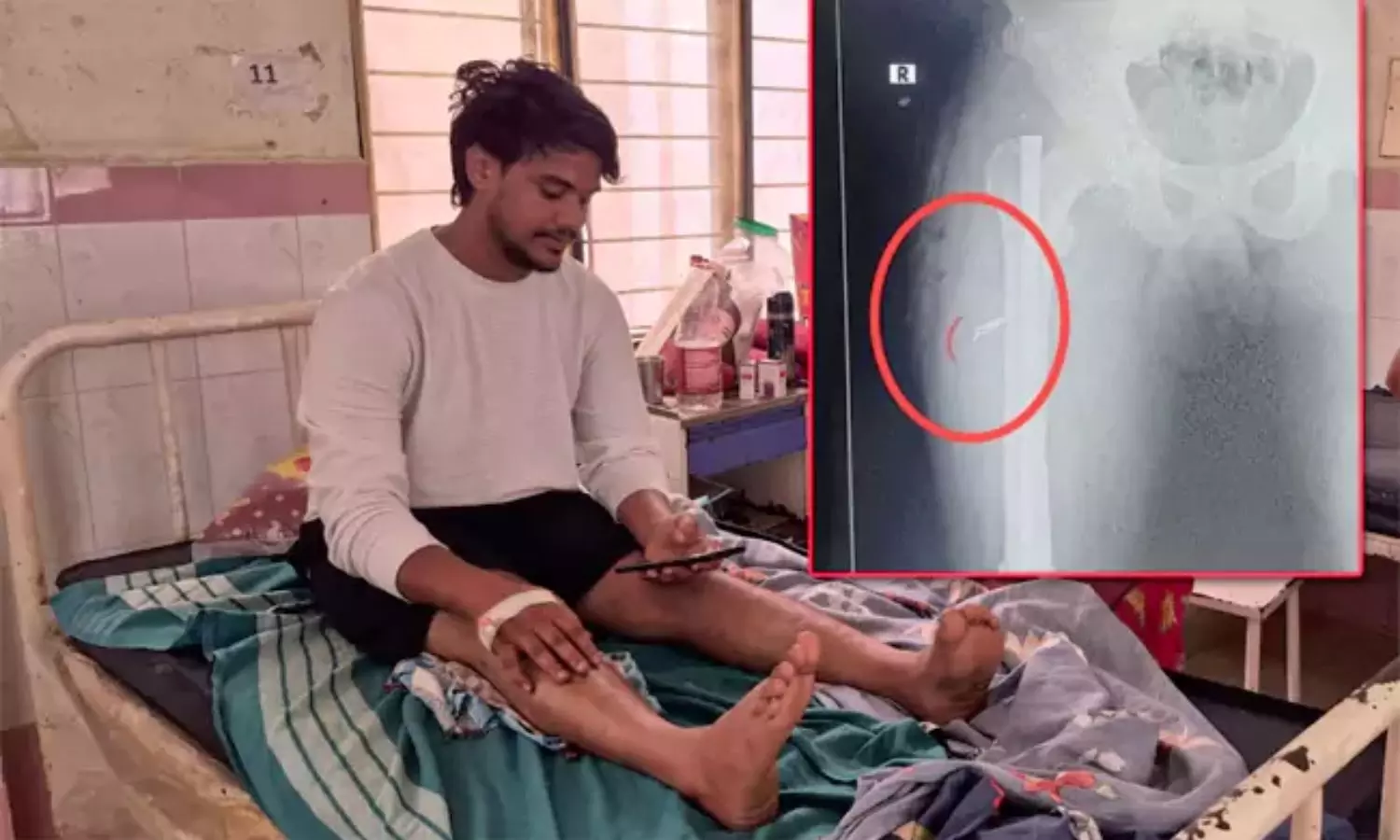 కాలికి శస్త్రచికిత్స.. సర్జికల్‌ బ్లేడ్‌ మర్చిపోయి కుట్లు వేసిన వైద్యులు