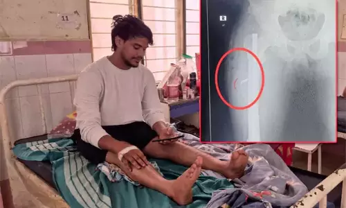 కాలికి శస్త్రచికిత్స.. సర్జికల్ బ్లేడ్ మర్చిపోయి కుట్లు వేసిన వైద్యులు కాలికి శస్త్రచికిత్స.. సర్జికల్ బ్లేడ్ మర్చిపోయి కుట్లు వేసిన వైద్యులు