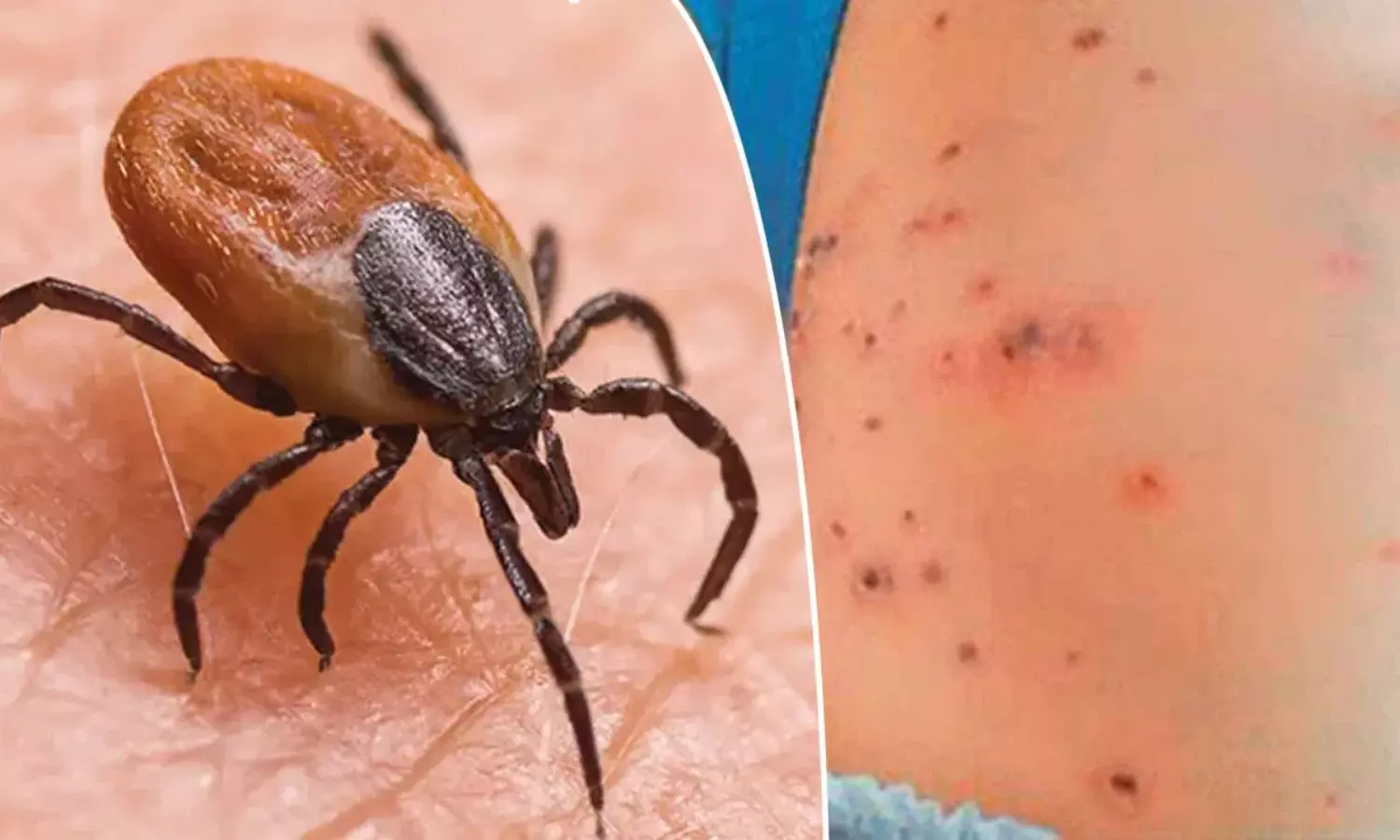 Scrub Typhus: ఏపీని వణికిస్తున్న స్క్రబ్‌ టైఫస్.. వరుస మరణాలు.. భయందోళనలో ప్రజలు