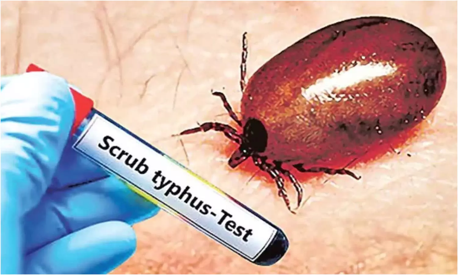 Scrub Typhus In AP: వామ్మో.. ఏపీలో భారీగా పెరుగుతున్న స్క్రబ్ టైఫస్ కేసులు.. 22 మంది మ్రుతి..!! Scrub Typhus In AP: వామ్మో.. ఏపీలో భారీగా పెరుగుతున్న స్క్రబ్ టైఫస్ కేసులు.. 22 మంది మ్రుతి..!!