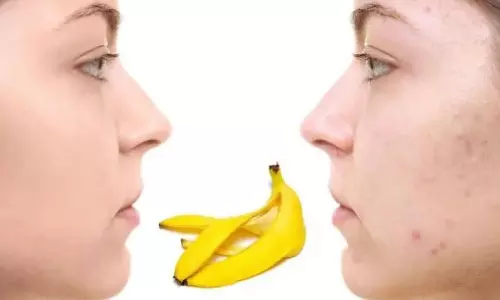 Health Tips: ముఖంపై మొటిమలకి అరటిపండుతో చెక్..!