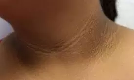 Dark Patches on Neck? అది మురికి కాదు.. ప్రమాదకరమైన జబ్బుకు సంకేతం!