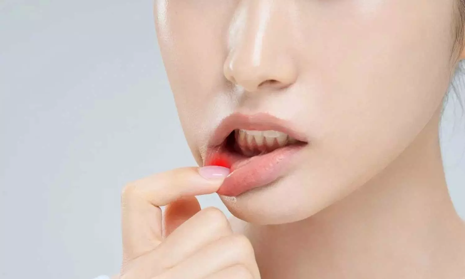 Mouth Ulcers Mouth Ulcers