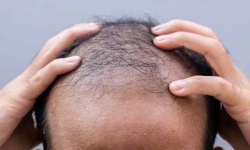 Hair Loss: పురుషుల్లో బట్టతలకు కూల్ డ్రింక్స్కు ఉన్న లింక్ ఏంటి? షాకింగ్ విషయాలు బయటపెట్టిన డాక్టర్లు Hair Loss: పురుషుల్లో బట్టతలకు కూల్ డ్రింక్స్కు ఉన్న లింక్ ఏంటి? షాకింగ్ విషయాలు బయటపెట్టిన డాక్టర్లు
