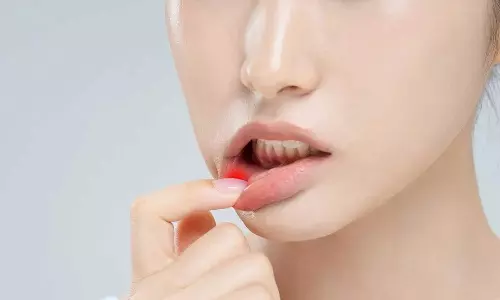 Mouth Ulcers Mouth Ulcers