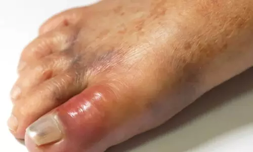 Uric Acid Causes: యూరిక్ యాసిడ్ సమస్య ఎందుకు వస్తుంది? నివారణకు పాటించాల్సిన చిట్కాలు Uric Acid Causes: యూరిక్ యాసిడ్ సమస్య ఎందుకు వస్తుంది? నివారణకు పాటించాల్సిన చిట్కాలు