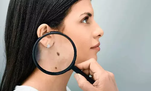 Lucky Moles Lucky Moles