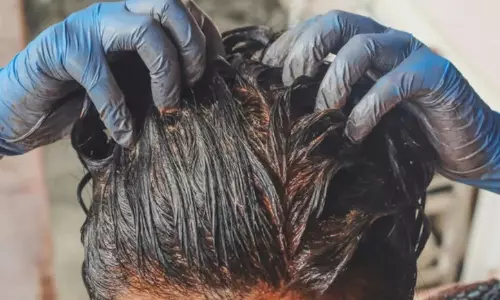 HairCare: ఖరీదైన హెయిర్ ట్రీట్‌మెంట్స్ వద్దు.. ఈ చిట్కాతో చుండ్రుకు చెక్‌పెట్టి.. సిల్కీ హెయిర్ సొంతం చేసుకోండి!