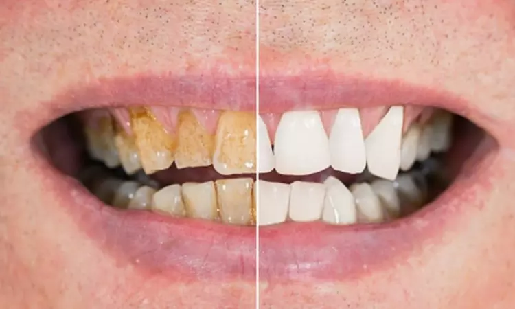 Dental Care: డెంటిస్ట్‌తో పనిలేదు.. ఈ చిట్కాలతో మీ దంతాలు ముత్యాల్లా మెరిసిపోవడం ఖాయం!